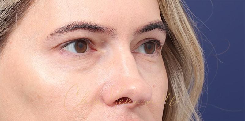 Rhinoplasty Before & After Photo