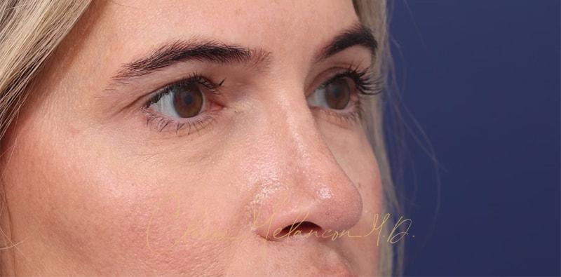 Rhinoplasty Before & After Photo