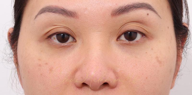 Rhinoplasty Before & After Photo