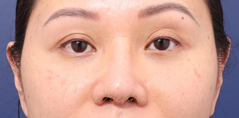 Rhinoplasty Before & After Photo