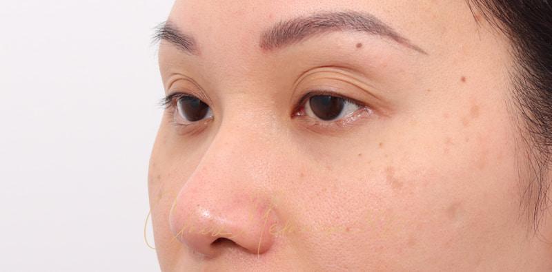 Rhinoplasty Before & After Photo