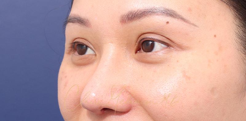 Rhinoplasty Before & After Photo
