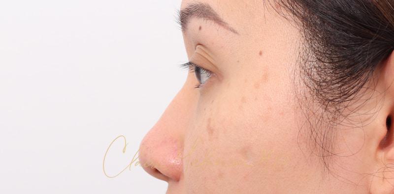 Rhinoplasty Before & After Photo