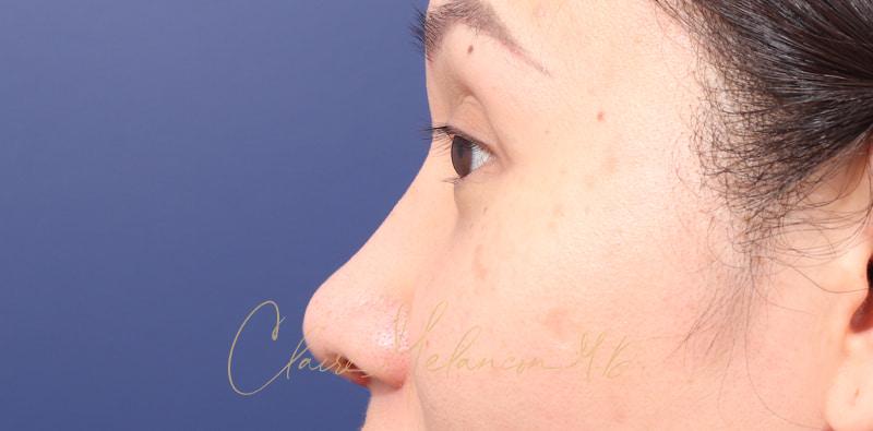 Rhinoplasty Before & After Photo