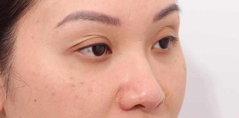 Rhinoplasty Before & After Photo