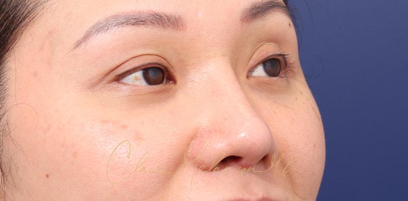 Rhinoplasty Before & After Photo