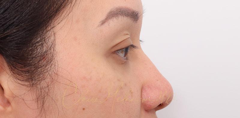 Rhinoplasty Before & After Photo