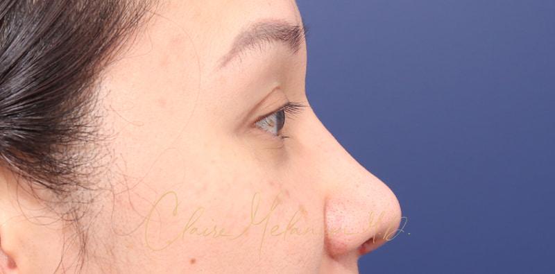 Rhinoplasty Before & After Photo