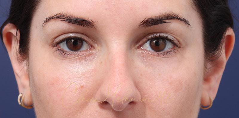 Rhinoplasty Before & After Photo