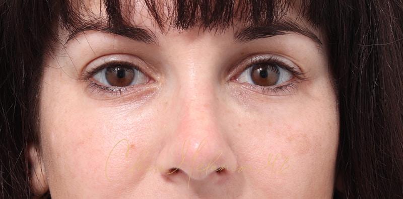 Rhinoplasty Before & After Photo