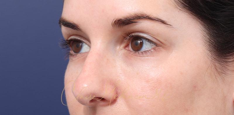 Rhinoplasty Before & After Photo