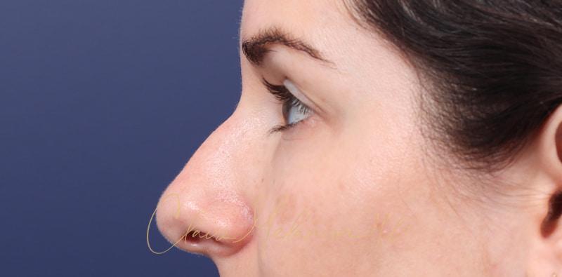 Rhinoplasty Before & After Photo