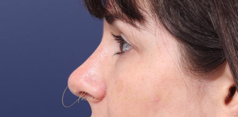 Rhinoplasty Before & After Photo