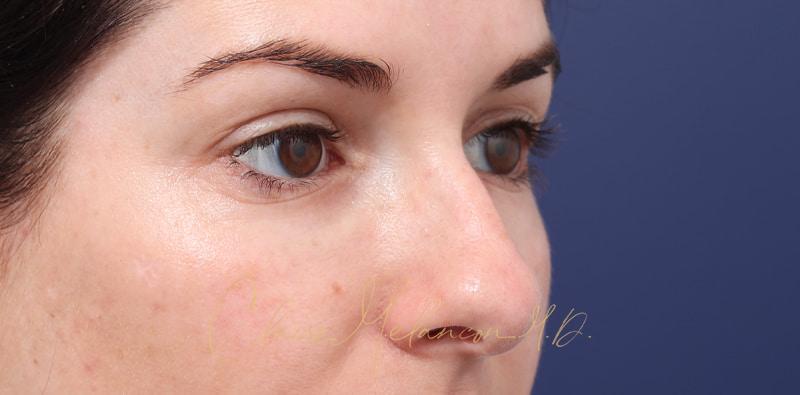 Rhinoplasty Before & After Photo