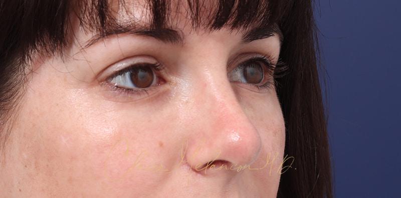 Rhinoplasty Before & After Photo