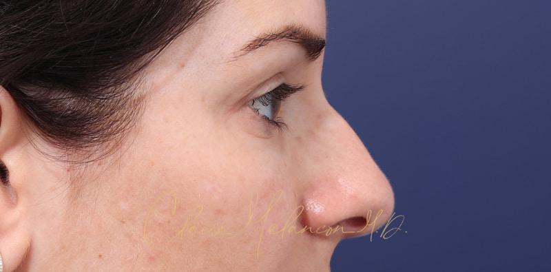 Rhinoplasty Before & After Photo