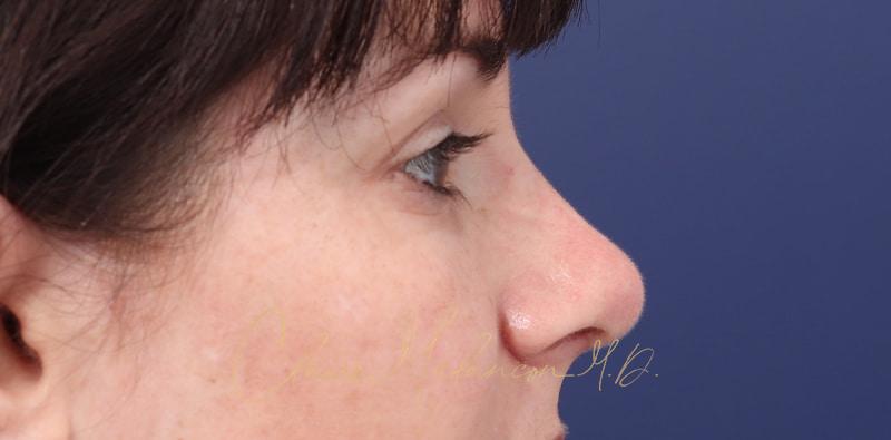 Rhinoplasty Before & After Photo
