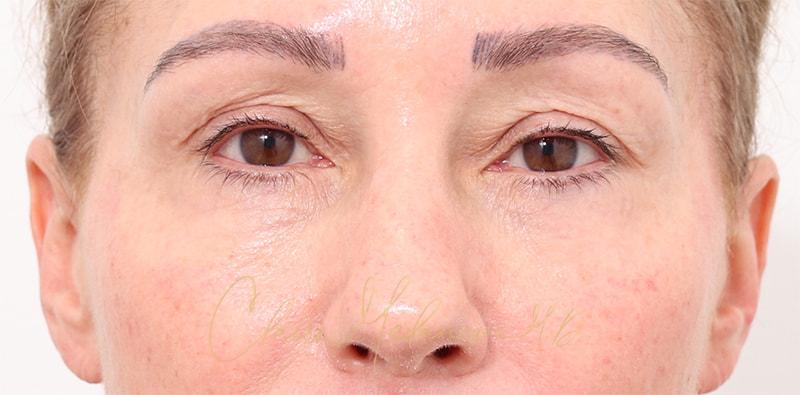 Rhinoplasty Before & After Photo