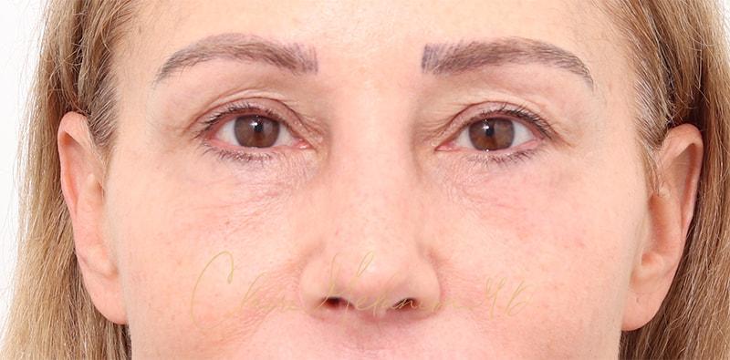 Rhinoplasty Before & After Photo