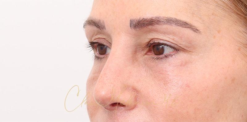 Rhinoplasty Before & After Photo