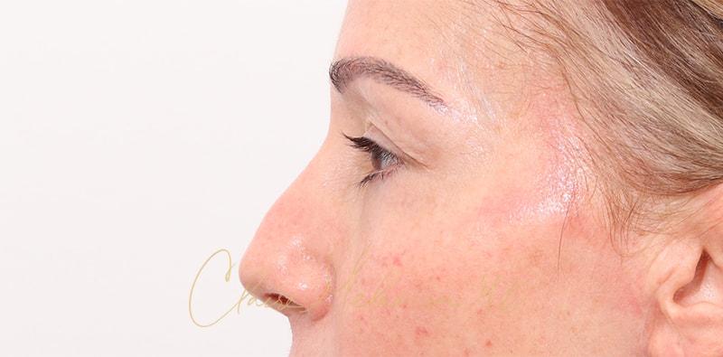 Rhinoplasty Before & After Photo