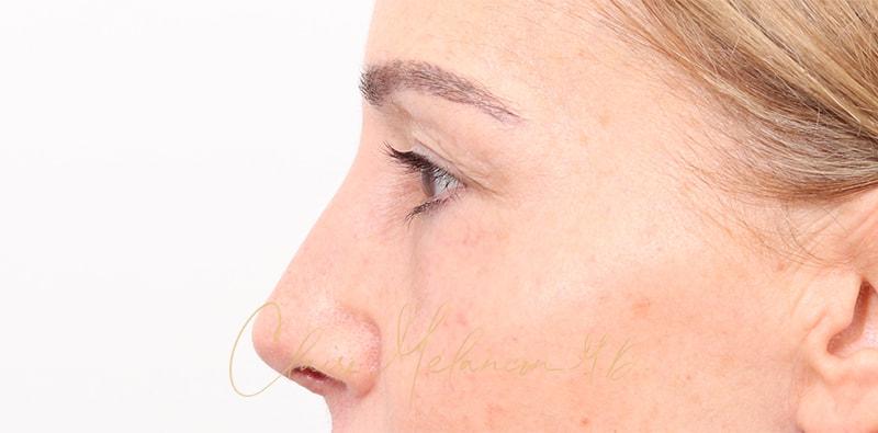 Rhinoplasty Before & After Photo