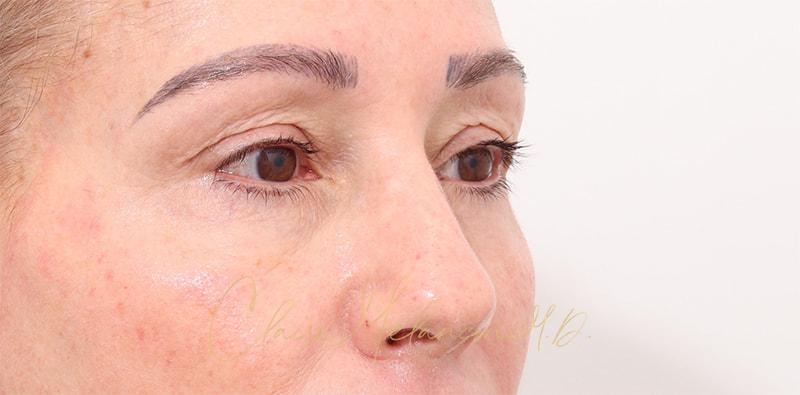 Rhinoplasty Before & After Photo