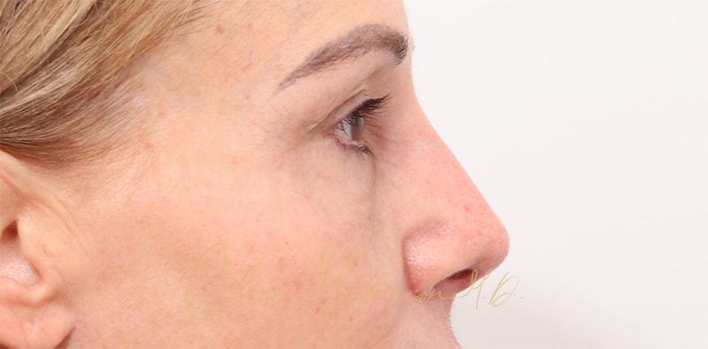 Rhinoplasty Before & After Photo