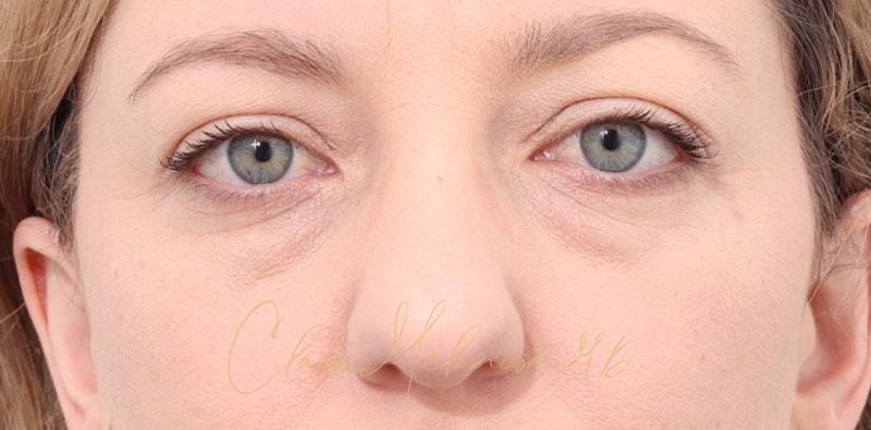 Rhinoplasty Before & After Photo