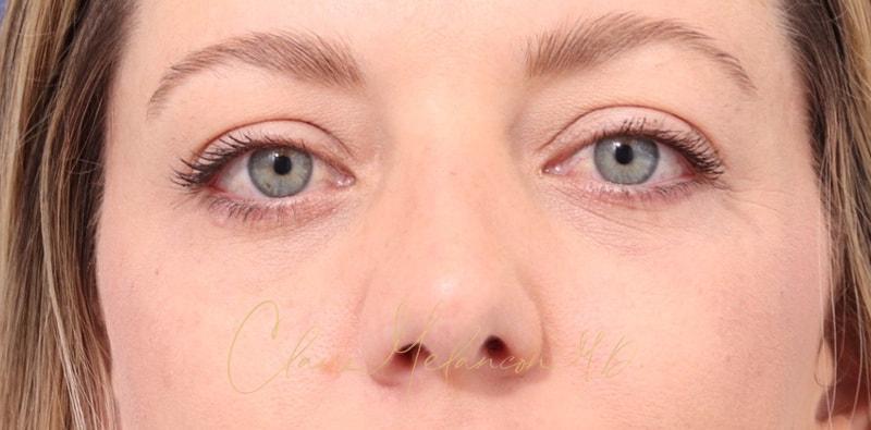 Rhinoplasty Before & After Photo
