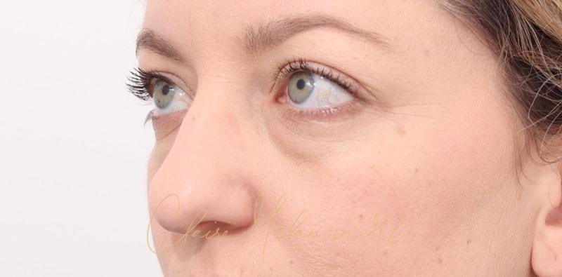 Rhinoplasty Before & After Photo
