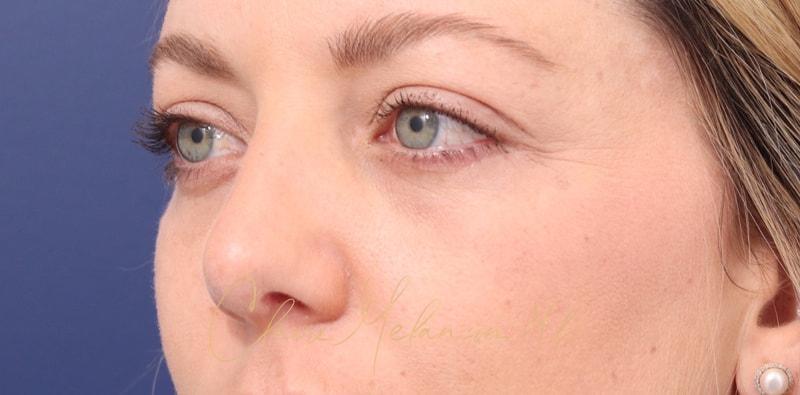 Rhinoplasty Before & After Photo