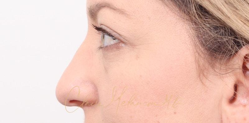 Rhinoplasty Before & After Photo