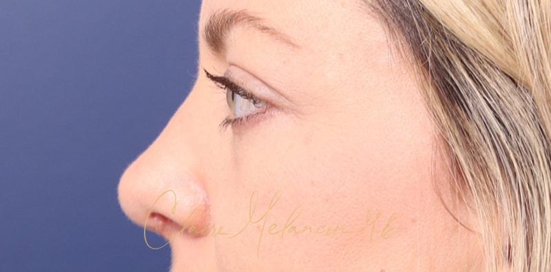 Rhinoplasty Before & After Photo