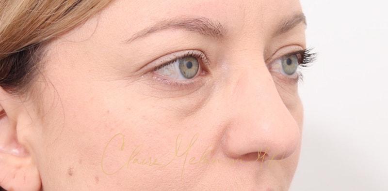 Rhinoplasty Before & After Photo