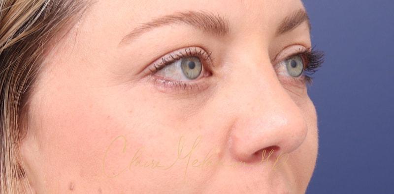 Rhinoplasty Before & After Photo