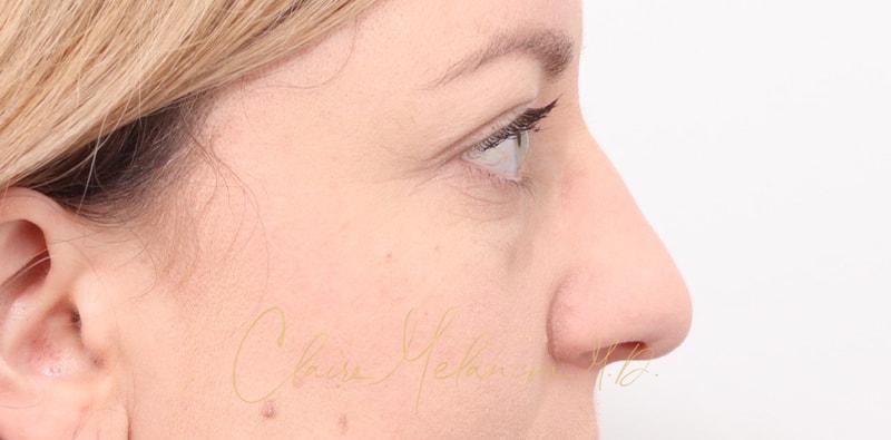 Rhinoplasty Before & After Photo