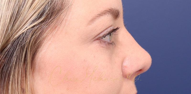 Rhinoplasty Before & After Photo