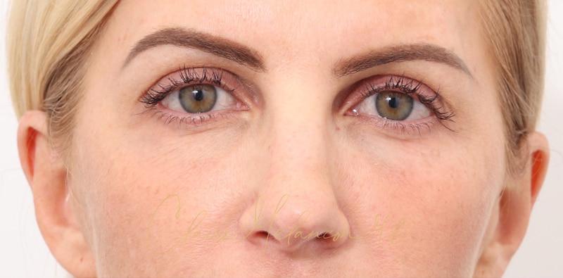 Rhinoplasty Before & After Photo