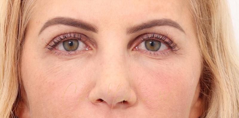 Rhinoplasty Before & After Photo