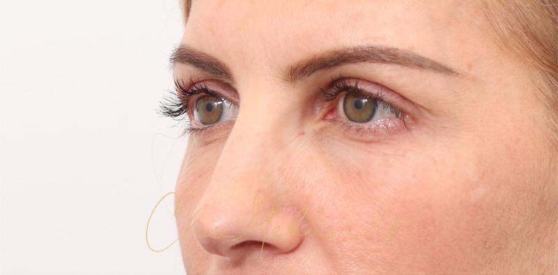 Rhinoplasty Before & After Photo