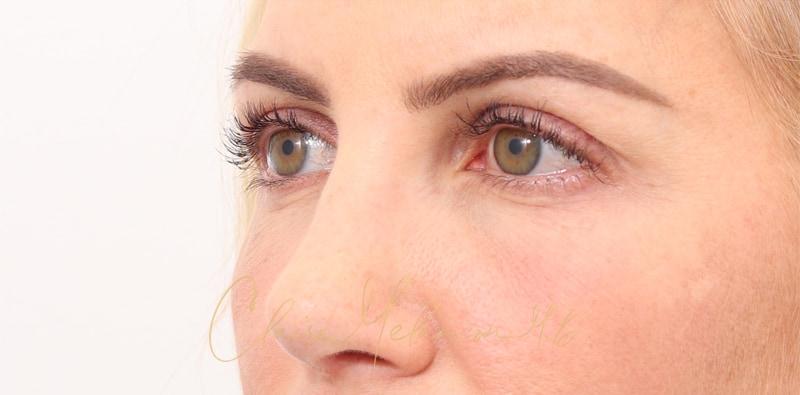 Rhinoplasty Before & After Photo