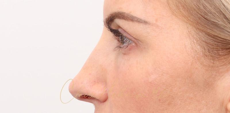 Rhinoplasty Before & After Photo