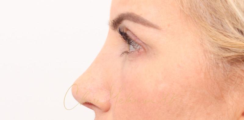 Rhinoplasty Before & After Photo