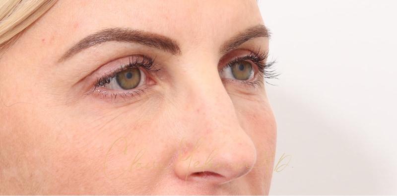 Rhinoplasty Before & After Photo