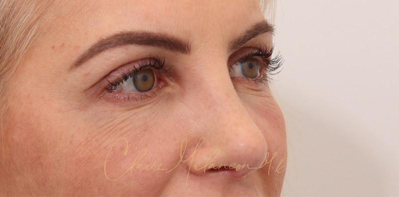 Rhinoplasty Before & After Photo