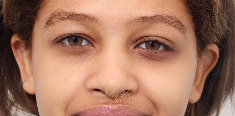 Rhinoplasty Before & After Photo