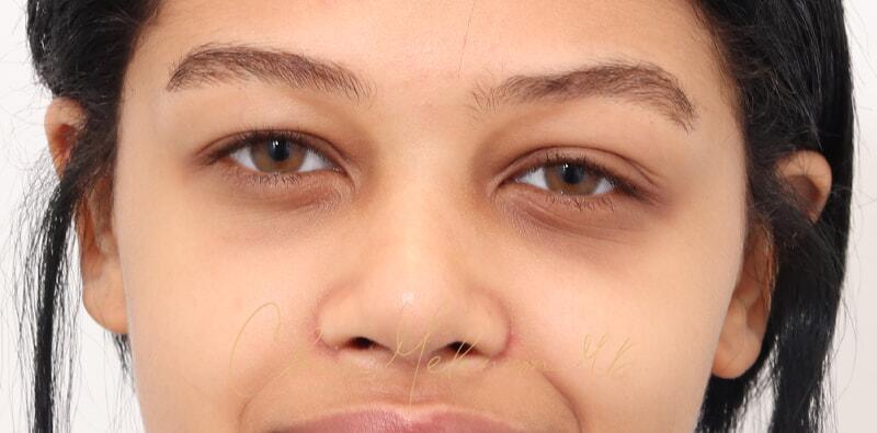 Rhinoplasty Before & After Photo