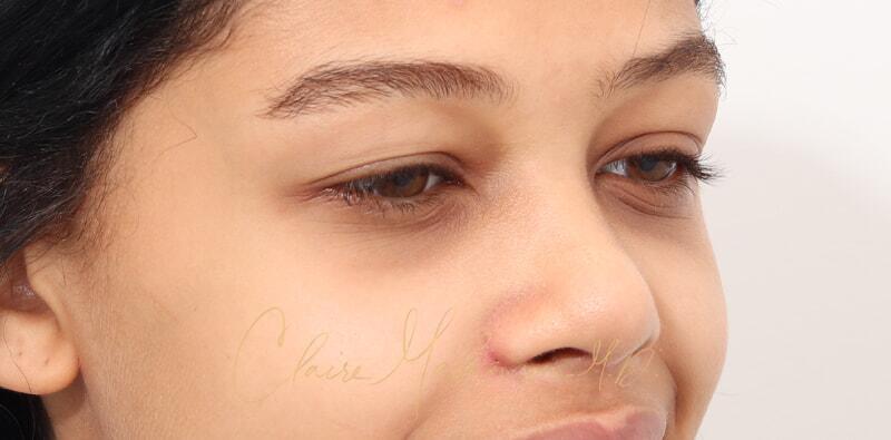 Rhinoplasty Before & After Photo