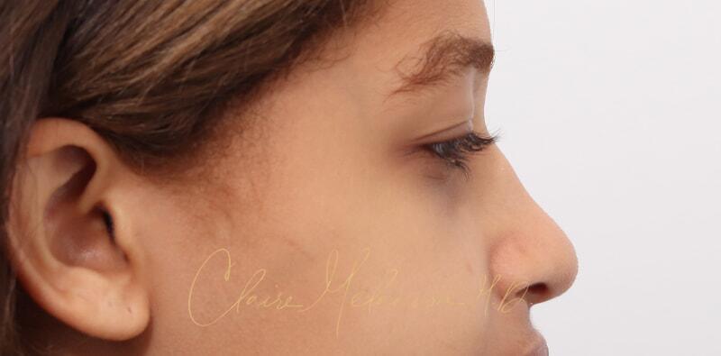 Rhinoplasty Before & After Photo